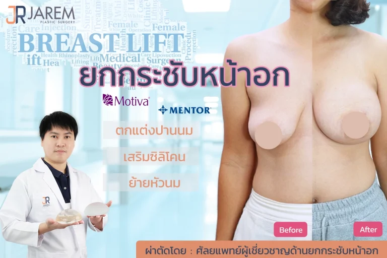 หน้าอกยาน นมคล้อย จบด้วยผ่าตัดยกกระชับหน้าอก Mastopexy