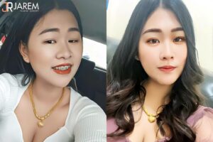 ตาสวย สดใส สบตากับใครก็มั่นใจ ไม่ต้องกังวลอีกต่อไป