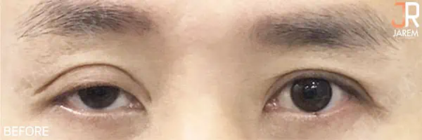 กล้ามเนื้อตาอ่อนแรงที่เป็นมาแต่กำเนิด