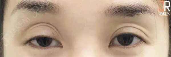 กล้ามเนื้อตาอ่อนแรงที่เป็นในภายหลัง