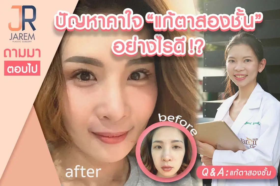 ปกบทความปัญหาคาใจ “แก้ตาสองชั้น”อย่างไรดี