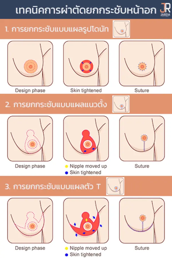 วิธีผ่าตัดยกกระชับหน้าอก