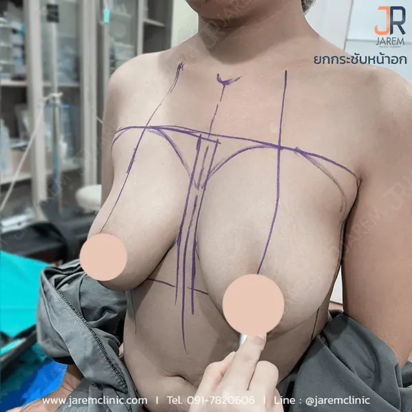การประเมินก่อนการศัลยกรรมยกกระชับทรวงอก