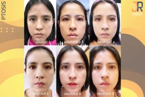 รักษากล้ามเนื้อตาอ่อนแรง ก่อนทำให้ใช้ชีวิตลำบาก