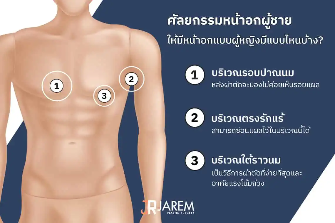 วิธีศัลยกรรมหน้าอกผู้ชายให้มีหน้าอกแบบผู้หญิง