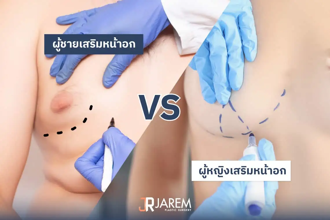 ผู้ชายเสริมหน้าอกให้เป็นผู้หญิง เปรียบเทียบกับ ผู้หญิงเสริมหน้าอก