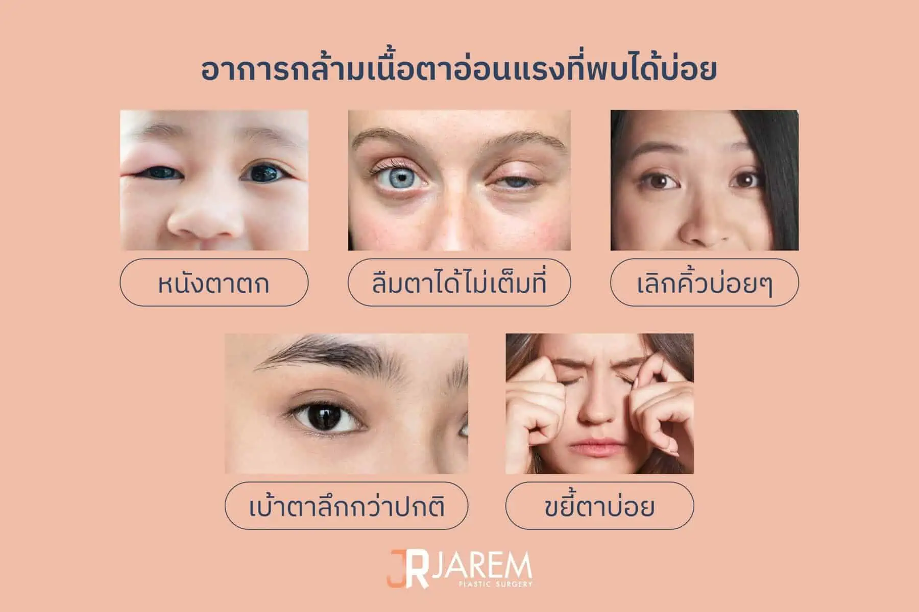 อาการกล้ามเนื้อตาอ่อนแรง