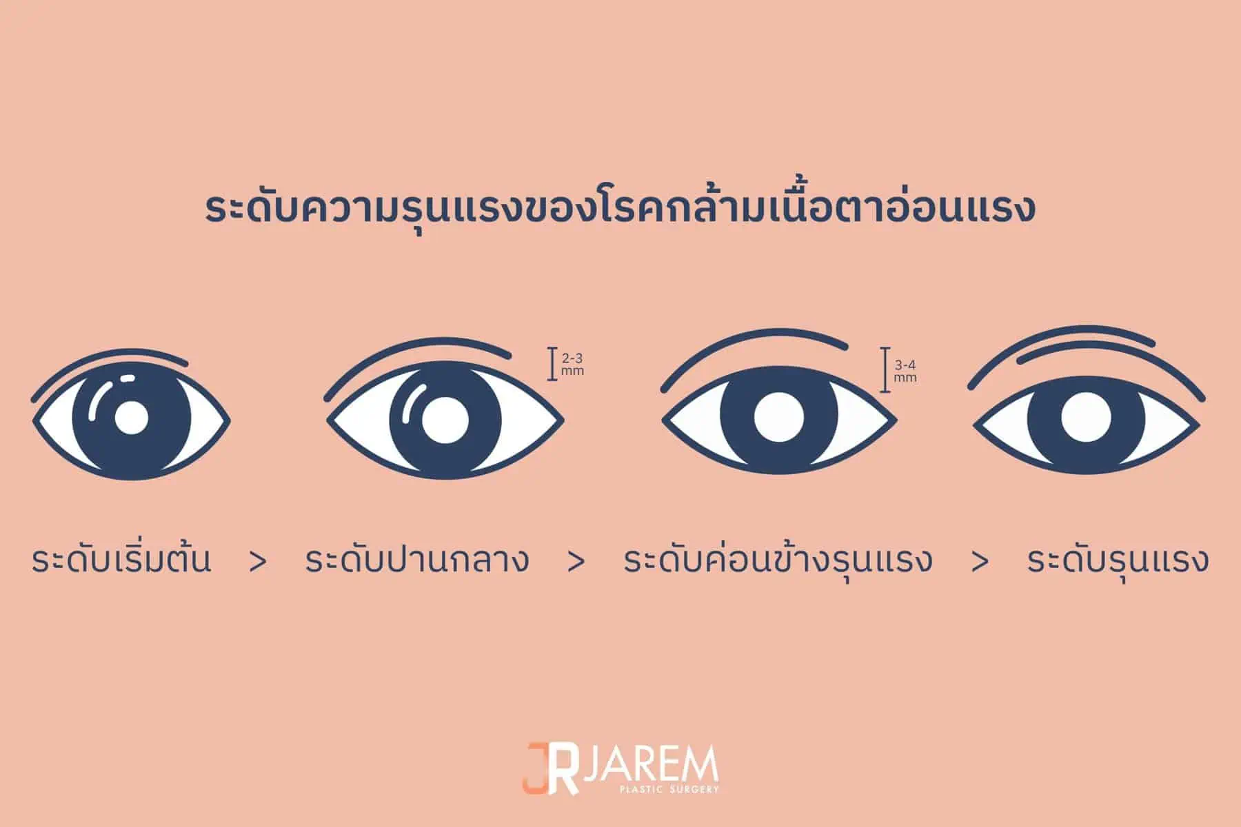 ระดับความรุนแรงของโรคกล้ามเนื้อตาอ่อนแรง