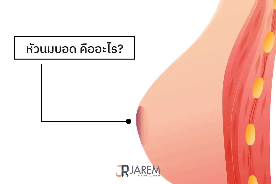 หัวนมบอดคืออะไร