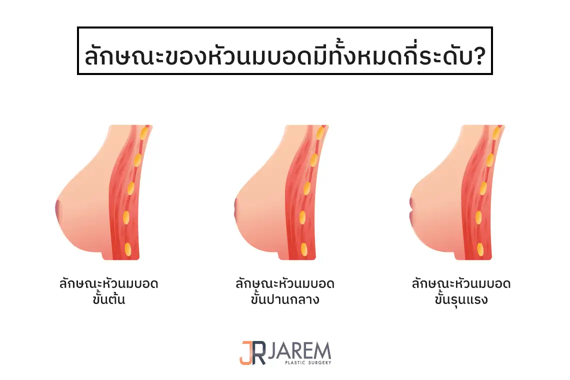 หัวนมบอดมีลักษณะอย่างไร