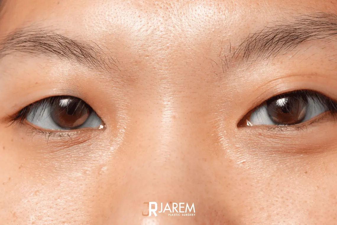 โรคตาขี้เกียจ