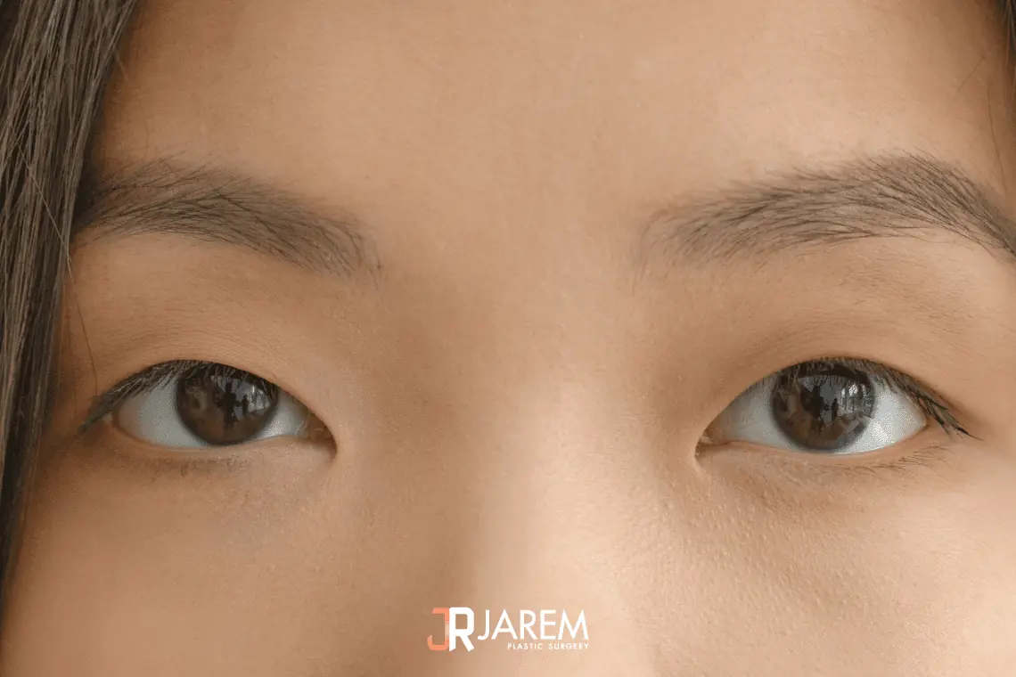 โรคตาขี้เกียจ