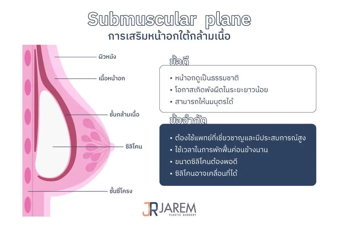 การเสริมหน้าอกใต้กล้ามเนื้อ