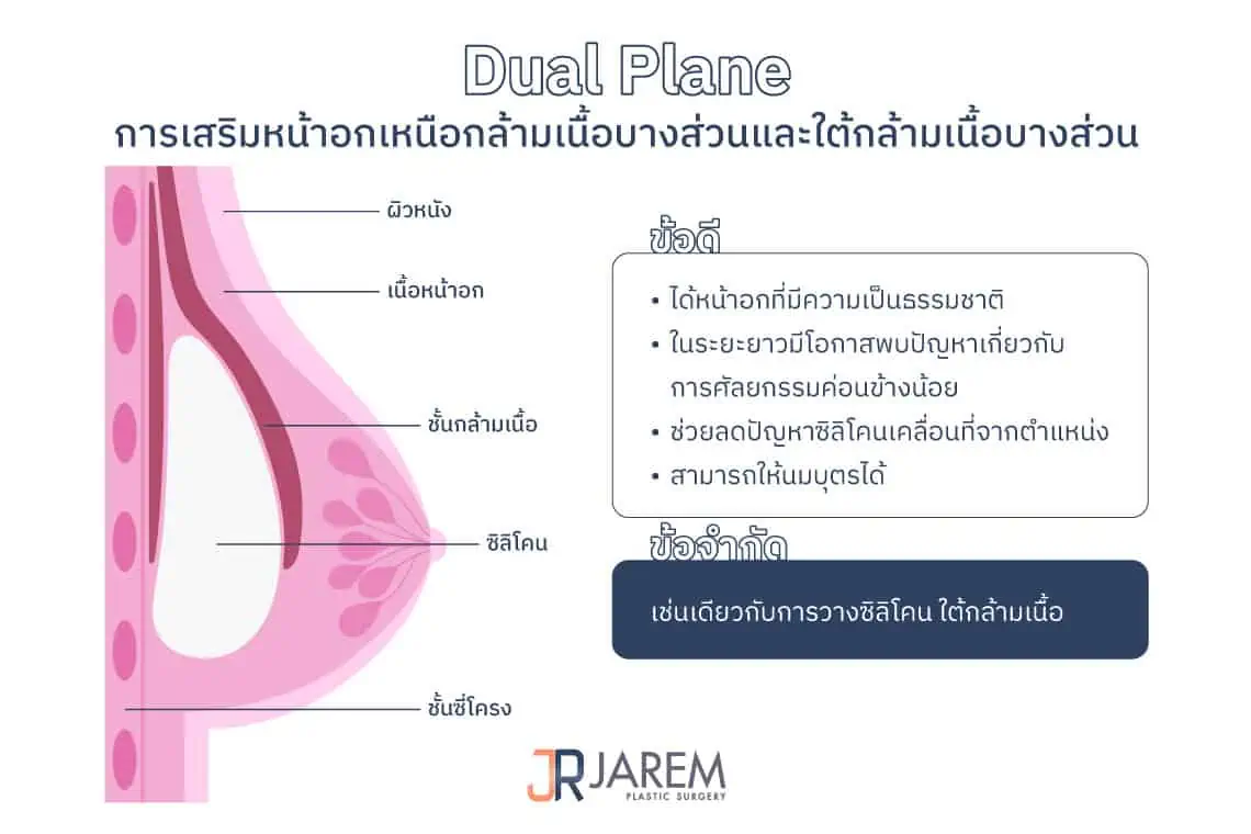 การเสริมหน้าอกแบบ Dual Plane