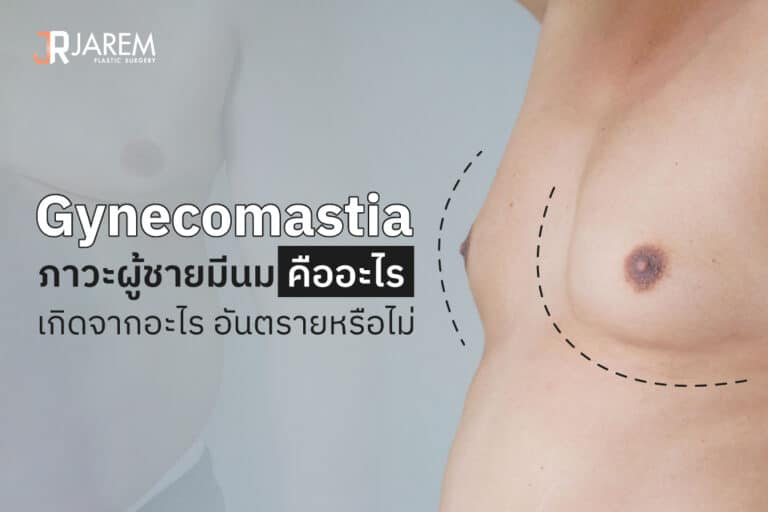 Gynecomastia ภาวะผู้ชายมีนมคืออะไร เกิดจากอะไร อันตรายหรือไม่