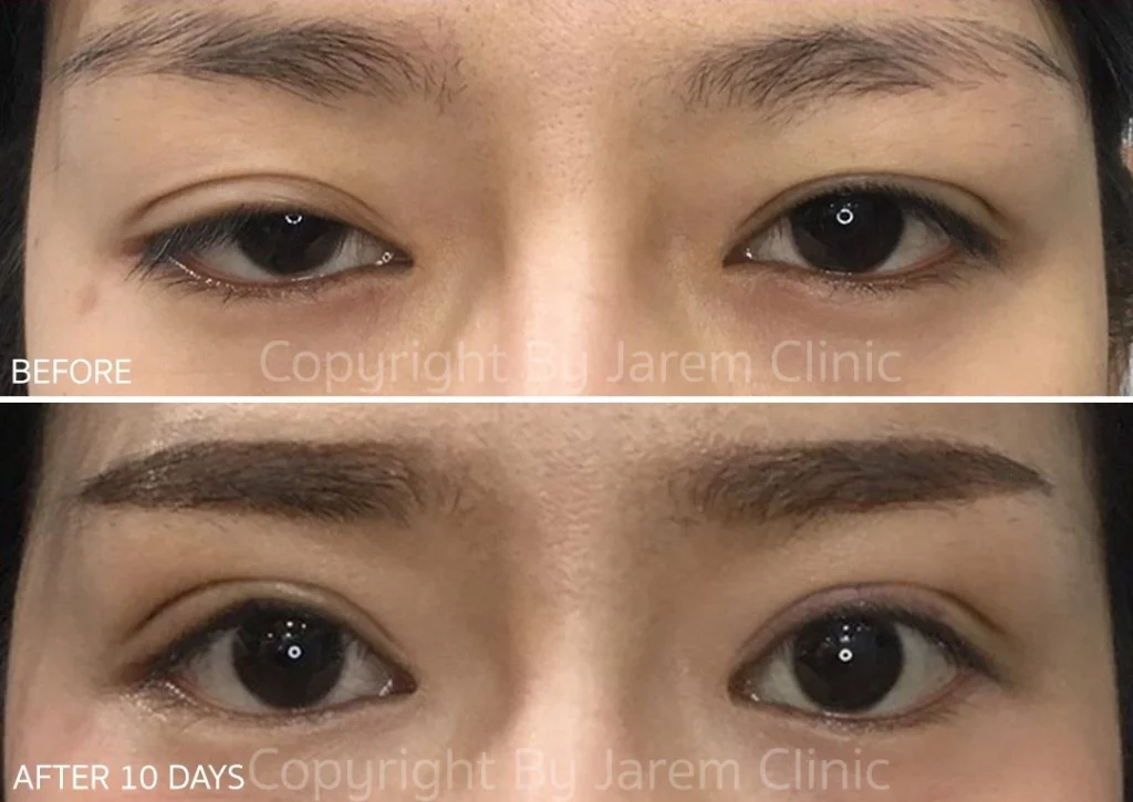 รีวิวผ่าตัดแก้ไขกล้ามเนื้อตาอ่อนแรงที่ Jarem Clinic โดย หมอยุ้ย