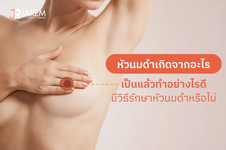 หัวนมดำเกิดจากอะไร เป็นแล้วทำอย่างไรดี มีวิธีรักษาหัวนมดำหรือไม่