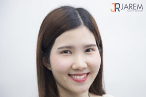 ทำตาสองชั้น แก้ไขกล้ามเนื้อตาอ่อนแรง ชั้นตาสวย ไม่เป็นหอยแครง