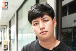 บอกลาตาง่วงนอน ตาปรือ จากภาวะกล้ามเนื้อตาอ่อนแรงแต่กำเนิด