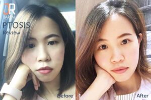 เรียกคืนดวงตาสวย ด้วยการผ่าตัดกล้ามเนื้อตาอ่อนแรง