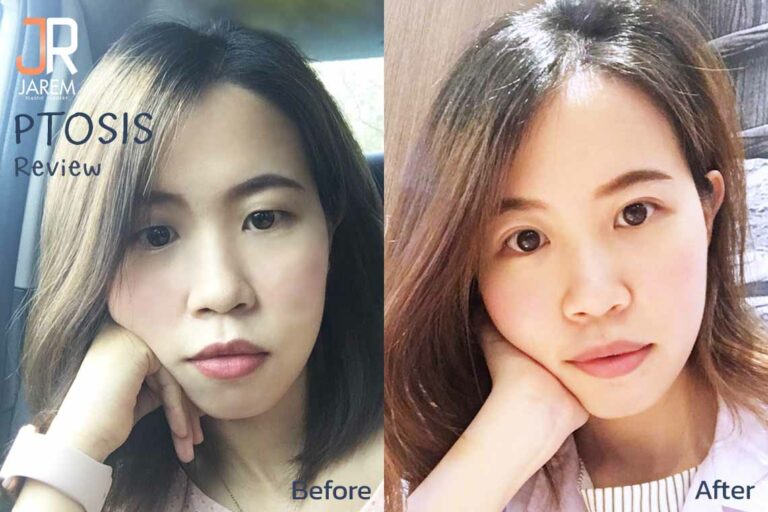 ทำตาสองชั้น กล้ามเนื้อตาอ่อนแรง