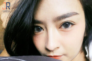 แก้ไขปัญหาตาตก ตาไม่เท่ากัน by จักษุแพทย์เฉพาะทาง