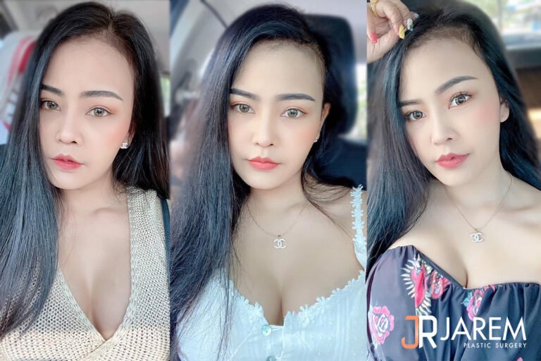 ทำหน้าอกที่ไหนดี