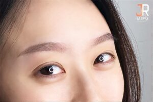 มาแจกความสดใส พร้อมตาคู่สวย หลังแก้ไขกล้ามเนื้อตาอ่อนแรง