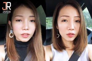 ตาเปลี่ยนหน้าก็เปลี่ยน หลังแก้ปัญหาโรคกล้ามเนื้อตาอ่อนแรง