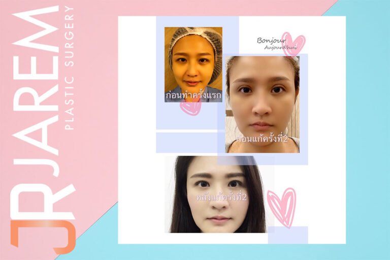 แก้ตาที่ไหนดี
