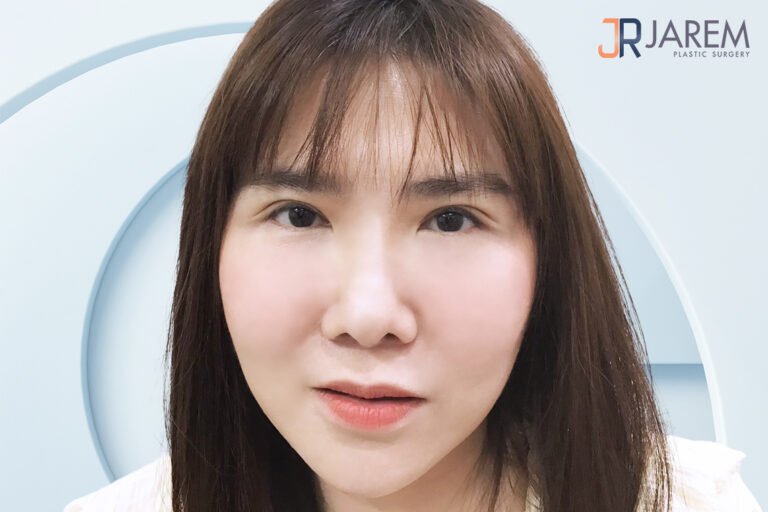 รีวิวแก้ตากับหมอยุ้ย