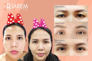 แก้ตา2ชั้น เปลี่ยนตาพัง ตาหอยแครง ชั้นตาไม่สมูท เป็นตาสวยๆ