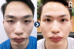 ชั้นตาไม่เท่ากัน หน้าดูเหนื่อยล้า อ่อนเพลีย เหมือนคนง่วงนอน ทำไงดี?