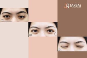 ตาตกข้างเดียวเกิดจากอะไร? ใช่กล้ามเนื้อตาอ่อนแรงหรือไม่ มาดูกัน?