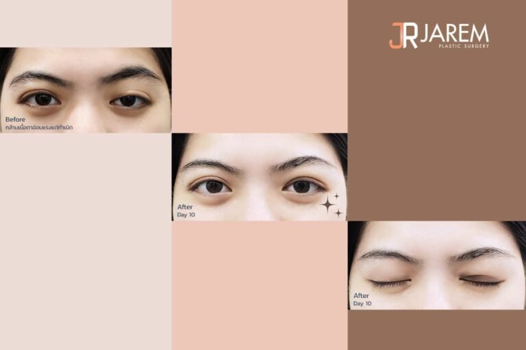 ตาตกข้างเดียว
