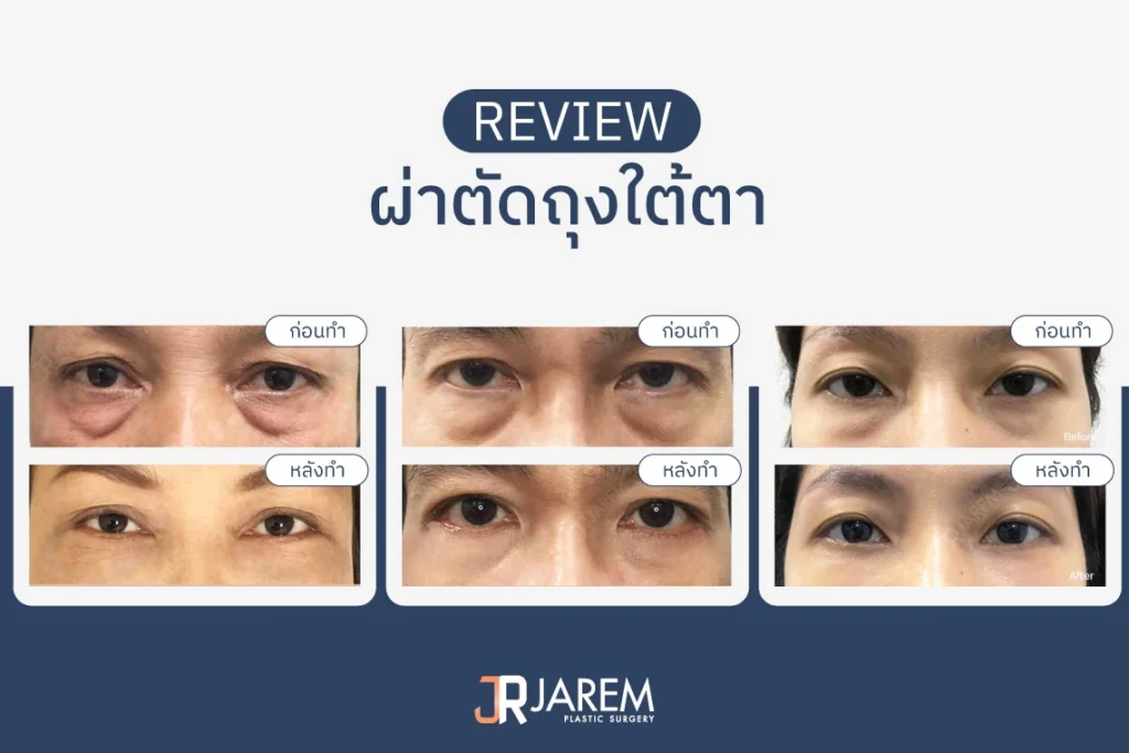 รีวิวแก้ไขถุงใต้ตา Jarem Clinic