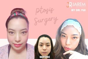 เปลี่ยนกล้ามเนื้อตาอ่อนแรง เป็นตาสวยๆสดใส สไตล์เกาหลี