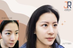 ทำตาสองชั้นที่ไหนดี? ไม่อยากได้ชั้นตาหนา ตาหอยแครง