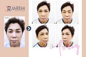 เปลี่ยนตาชั้นเดียว ตาตก ให้เป็นตาสองชั้นสวยๆ กระชากวัย