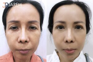 แก้หนังตาตก ตาปรือ กล้ามเนื้อตาอ่อนแรง กับหมอยุ้ย จาเรมคลินิก