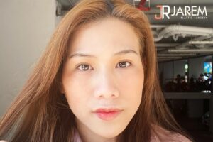 ทำตาที่จาเรมคลินิก ได้ทั้งศัลยกรรมตาและรักษากล้ามเนื้อตาอ่อนแรง