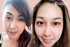 รีวิวกล้ามเนื้อตาอ่อนแรงแต่กำเนิด และวิธีการสังเกตตัวเอง