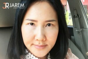 ชั้นตาสวยเป๊ะ! ลาขาดจากปัญหากล้ามเนื้อตาอ่อนแรงที่เกิดขึ้นตามวัย