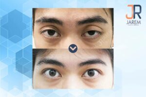 รักษากล้ามเนื้อตาอ่อนแรงแต่กำเนิดที่จาเรมคลินิก คลินิกดีๆที่คุณแม่แนะนำ