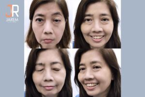 เปลี่ยนตัวเองให้ดูดีขึ้น หลังรักษาโรคกล้ามเนื้อตาอ่อนแรงแต่กำเนิด