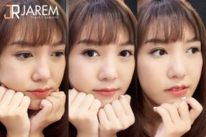 รีวิวทำตาสองชั้นแบบชั้นตาเล็ก พร้อมแก้ไขกล้ามเนื้อตาอ่อนแรง