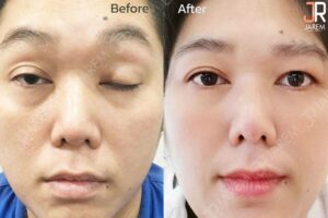 รักษากล้ามเนื้อตาอ่อนแรงแต่กำเนิด ด้วยการ “ร้อยเอ็นเทียม”