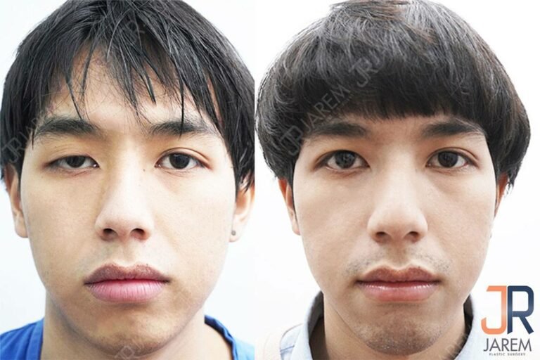 อาการกล้ามเนื้อตาอ่อนแรงแต่กำเนิด