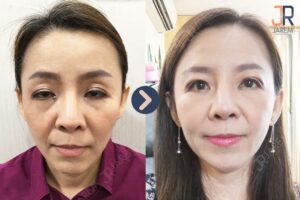 ตาปรือ ลืมตาไม่สุด เกิดจากสาเหตุใดได้บ้าง? มาดูกัน