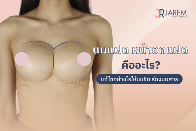 นมแฝด หน้าอกแฝด คืออะไร? แก้ไขอย่างไรให้นมชิด ร่องนมสวย